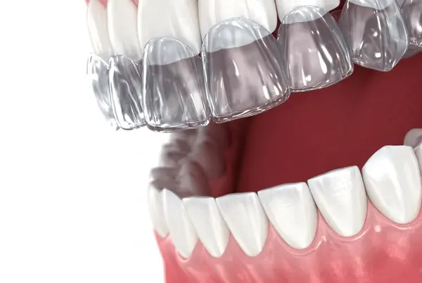 clear aligners in mississauga, on
