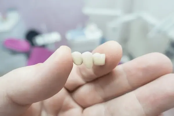 dental-bridges-in-mississauga-on