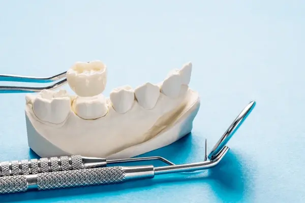 dental-crowns-in-mississauga-on