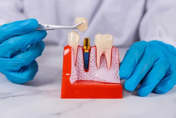 dental implants near you