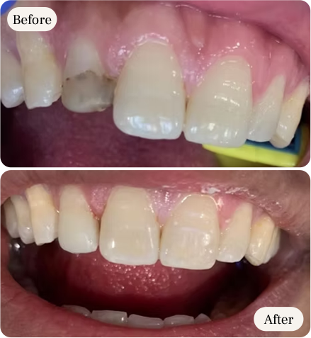smile transformation before and after by dentist in mississauga