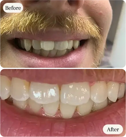 teeth whitening and restoration before and after by dentist in mississauga