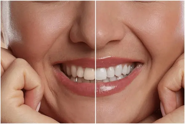 teeth whitening near you
